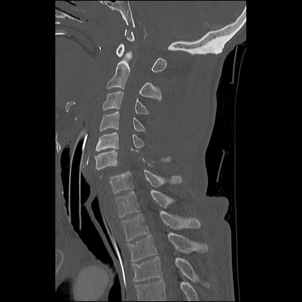 File:Bilateral perched facets with cord injury (Radiopaedia 45587-49713 Sagittal bone window 27).jpg