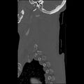 Bilateral perched facets with cord injury (Radiopaedia 45587-49713 Sagittal bone window 44).jpg