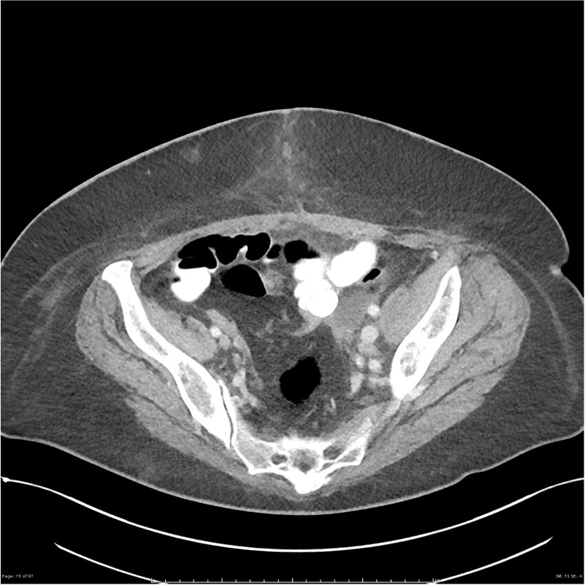 Bilateral psoas hematomas (Radiopaedia 24057-24279 A 71).jpg