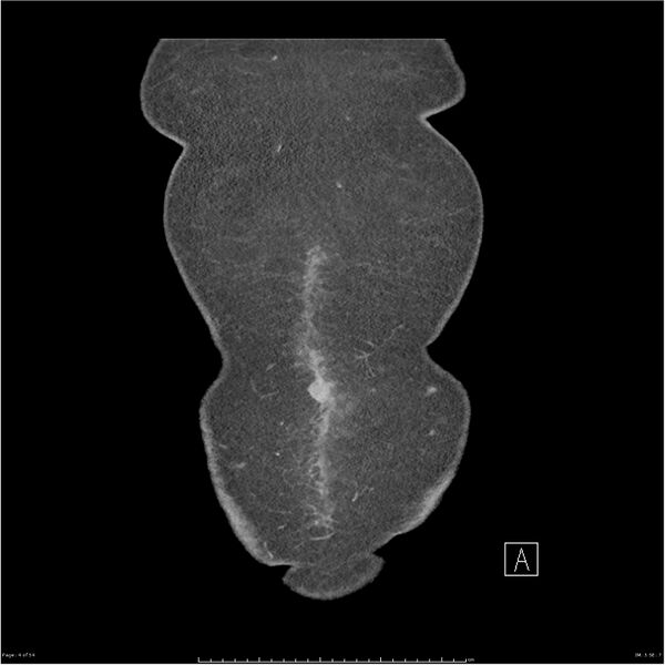 File:Bilateral psoas hematomas (Radiopaedia 24057-24279 B 4).jpg