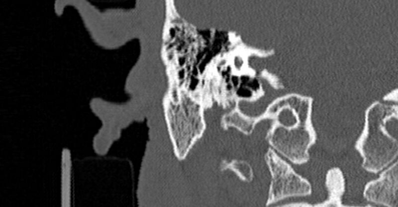 File:Bilateral temporal bone fractures (Radiopaedia 29482-29970 Coronal non-contrast 123).jpg