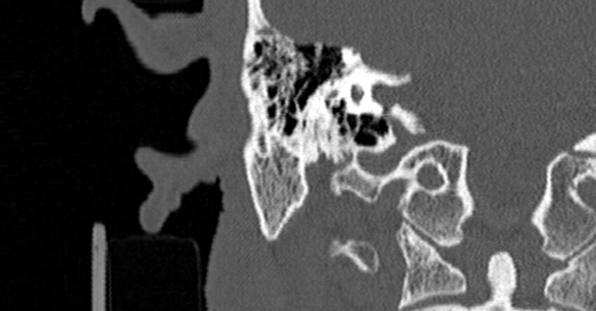 Bilateral temporal bone fractures (Radiopaedia 29482-29970 Coronal non-contrast 123).jpg