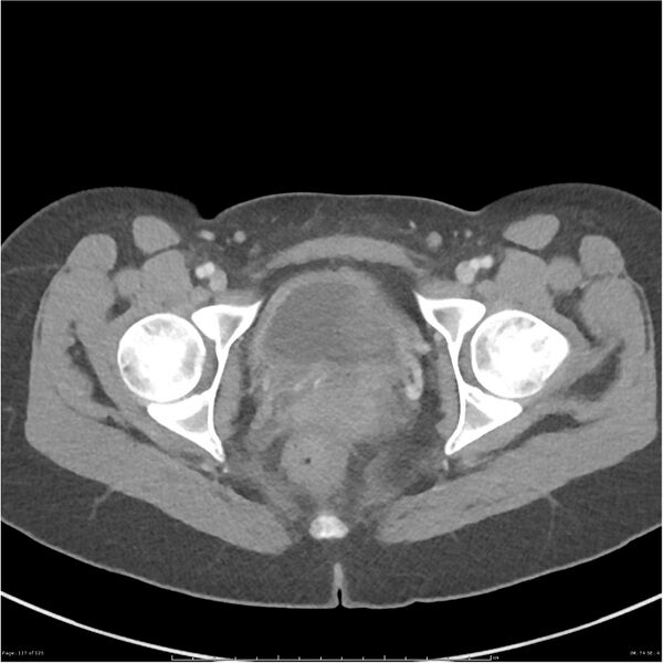 File:Bilateral ureteritis and cystitis (Radiopaedia 25340-25594 A 74).jpg