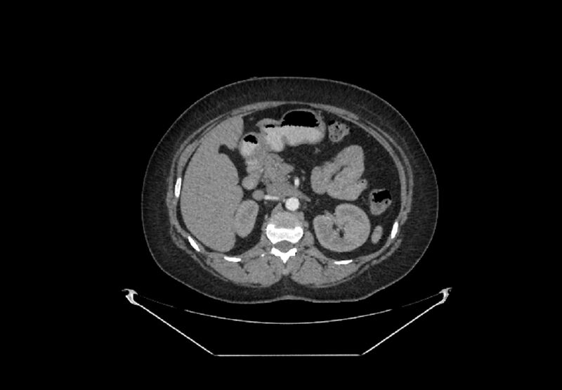 File:Bilateral urolithiasis with incidentally detected splenic artery aneurysm and left inferior vena cava (Radiopaedia 44467-48127 A 30).jpg