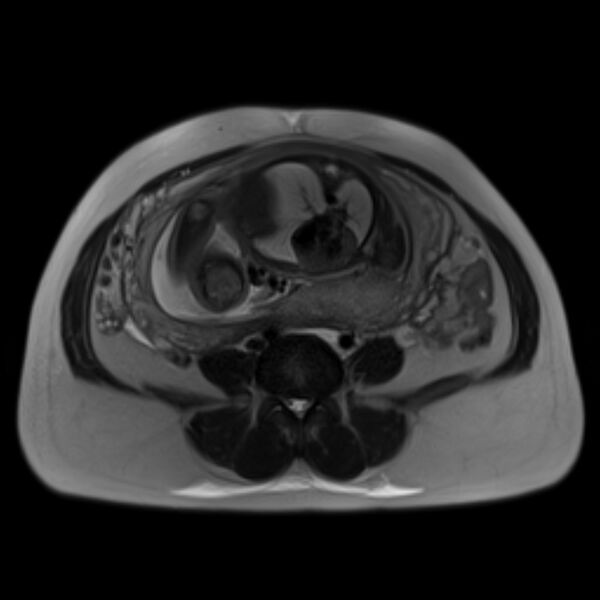 File:Bilobed placenta accreta (Radiopaedia 69648-79591 Axial T2 24).jpg
