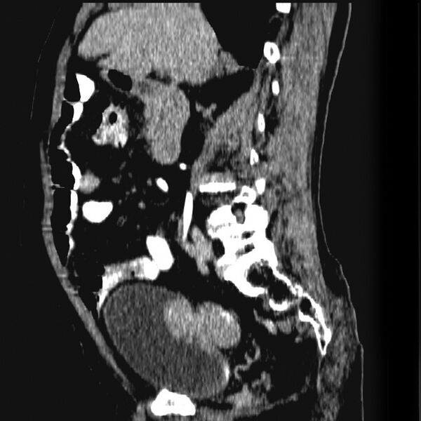 File:Bladder carcinoma in a diverticulum (Radiopaedia 6421-7780 Sagittal C+ delayed 1).jpg