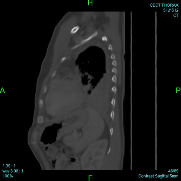 File:Bone metastases from lung carcinoma (Radiopaedia 54703-60937 Sagittal bone window 46).jpg