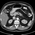 Bosniak cyst - type IV (Radiopaedia 23525-23627 renal cortical phase 11).jpg