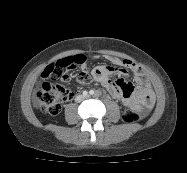 File:Bowel lymphoma complicated by bleeding after therapy (Radiopaedia 55601-62107 A 48).jpg