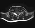 Brachial plexus birth palsy (Radiopaedia 68118-77604 Axial T2 15).jpg