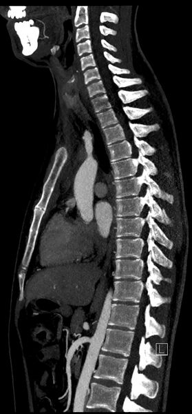 File:Brachiocephalic trunk pseudoaneurysm (Radiopaedia 70978-81191 C 49).jpg