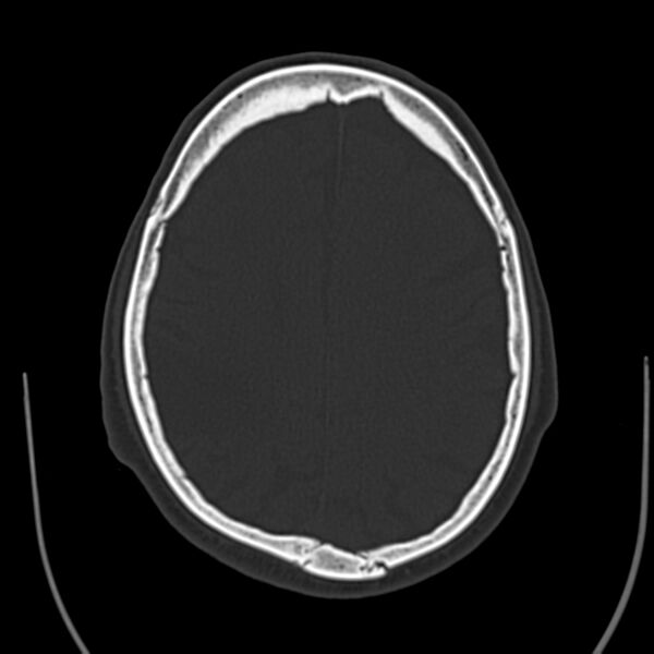 File:Brain Pantopaque remnants (Radiopaedia 78403-91048 Axial bone window 47).jpg