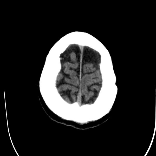 File:Brain Pantopaque remnants (Radiopaedia 78403-91048 Axial non-contrast 82).jpg