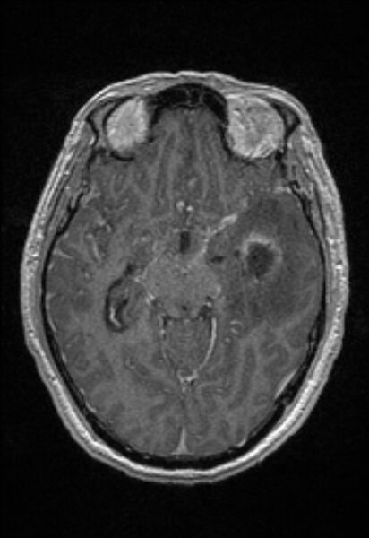 File:Brain abscess with ventriculitis (Radiopaedia 85703-101495 Axial T1 C+ 77).jpg