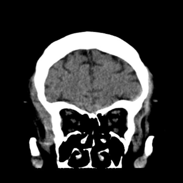 File:Brain cortical laminar necrosis (Radiopaedia 25822-25971 C 13).jpg