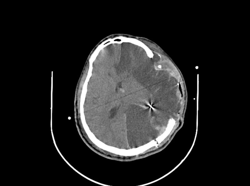 File:Brain injury by firearm projectile (Radiopaedia 82068-96087 B 115).jpg