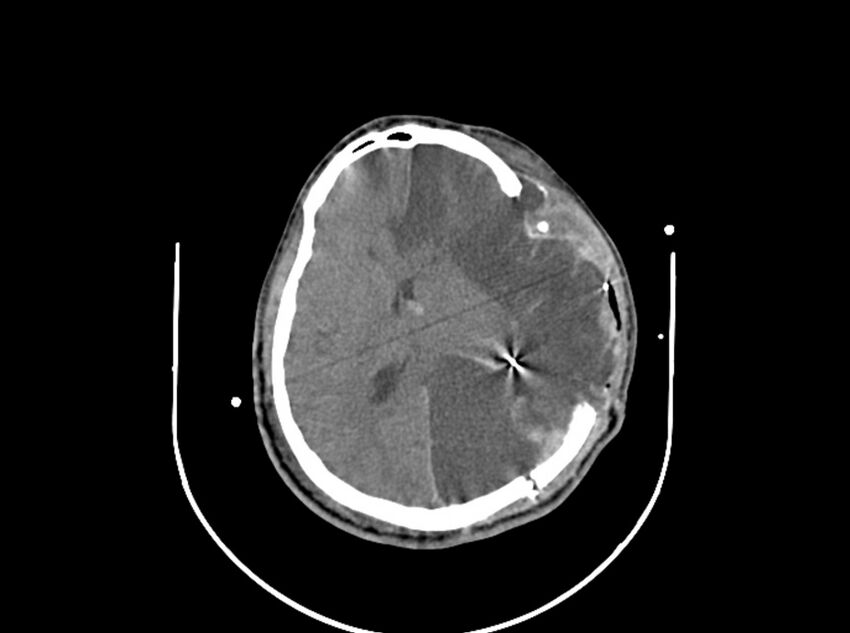 Brain injury by firearm projectile (Radiopaedia 82068-96087 B 115).jpg