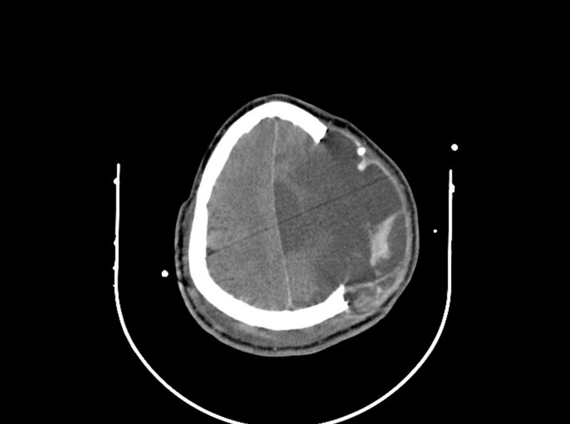 File:Brain injury by firearm projectile (Radiopaedia 82068-96087 B 146).jpg