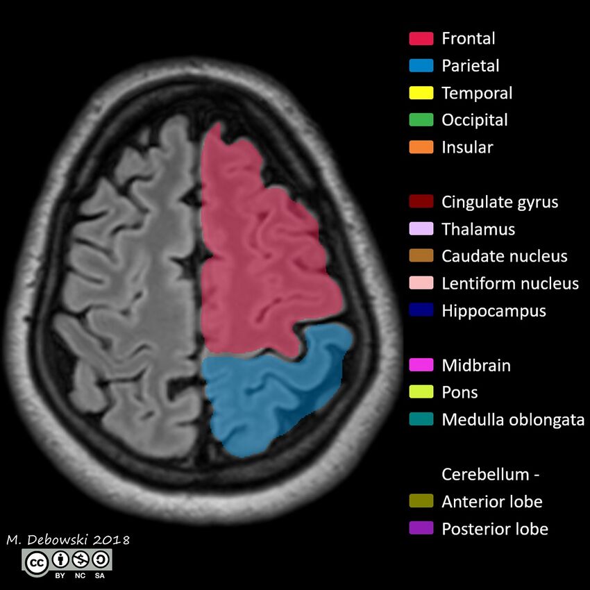 Brain lobes - annotated MRI (Radiopaedia 61691-69700 Axial 12).JPG