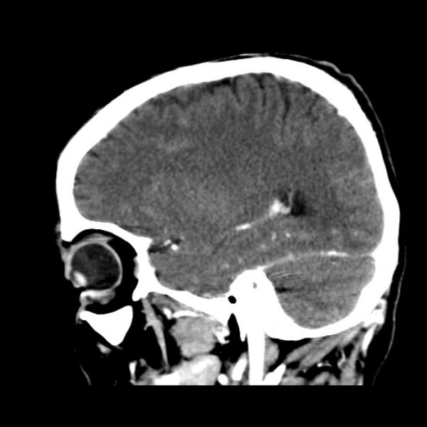 File:Brain metastases from lung cancer (Radiopaedia 24480-24781 C+ delayed 18).jpg