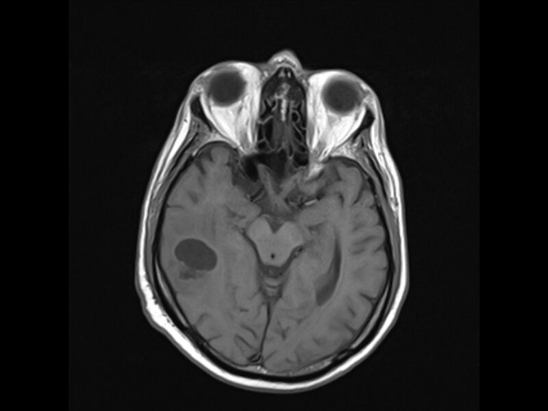 File:Brain metastases from renal cell carcinoma (Radiopaedia 42222-45297 Axial T1 11).jpg