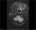 Brainstem glioma (Radiopaedia 21819-21775 Axial FLAIR 5).jpg