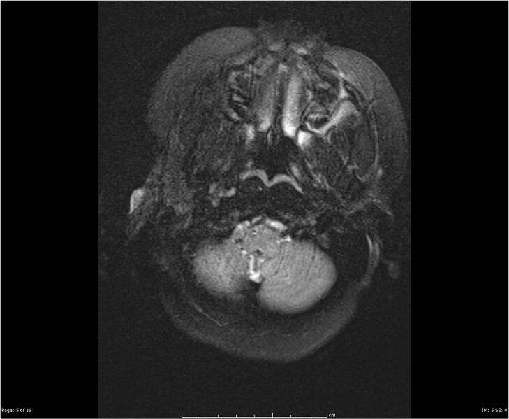 File:Brainstem glioma (Radiopaedia 21819-21775 Axial FLAIR 5).jpg