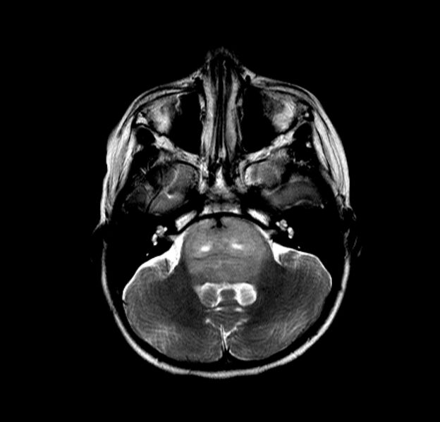 File:Brainstem glioma (Radiopaedia 5683-7390 Axial T2 2).jpg