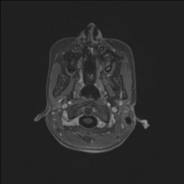 File:Brainstem glioma (Radiopaedia 70548-80674 Axial T1 C+ 14).jpg