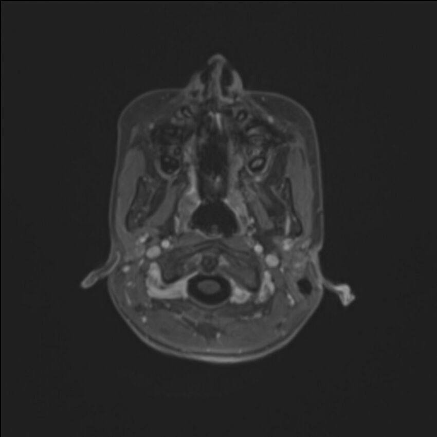 Brainstem glioma (Radiopaedia 70548-80674 Axial T1 C+ 14).jpg