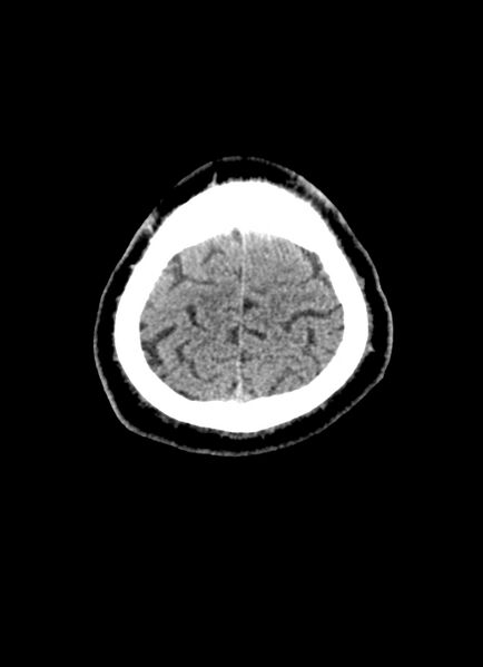 File:Brainstem hemorrhage (Radiopaedia 81294-94976 Axial non-contrast 10).jpg