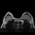Breast implants - MRI (Radiopaedia 26864-27035 Axial T2 31).jpg