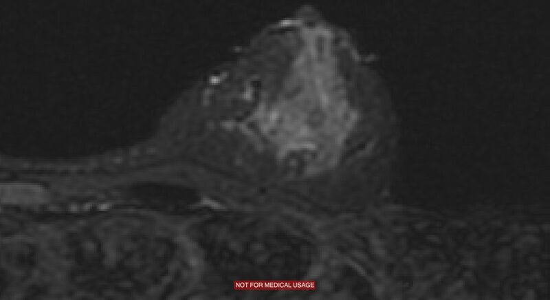 File:Breast lymphoma (MRI) (Radiopaedia 34999-36498 Axial STIR 2).jpg