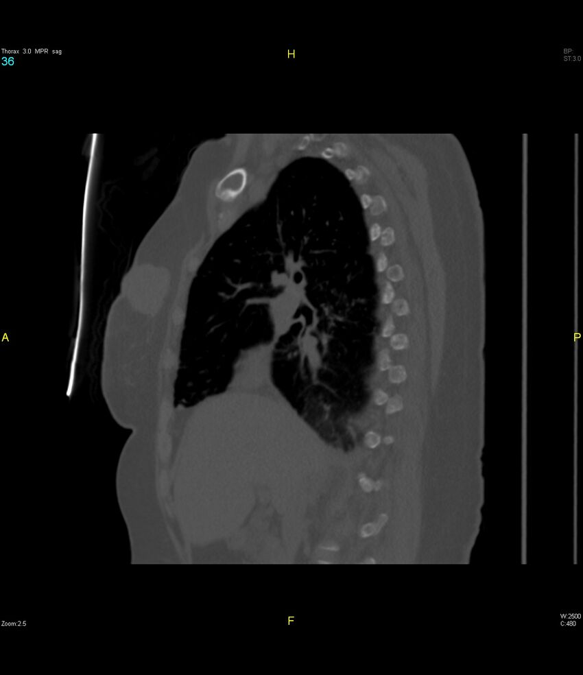 Breast primary with lung and bone metastases (Radiopaedia 40620-43228 Sagittal bone window 36).jpg