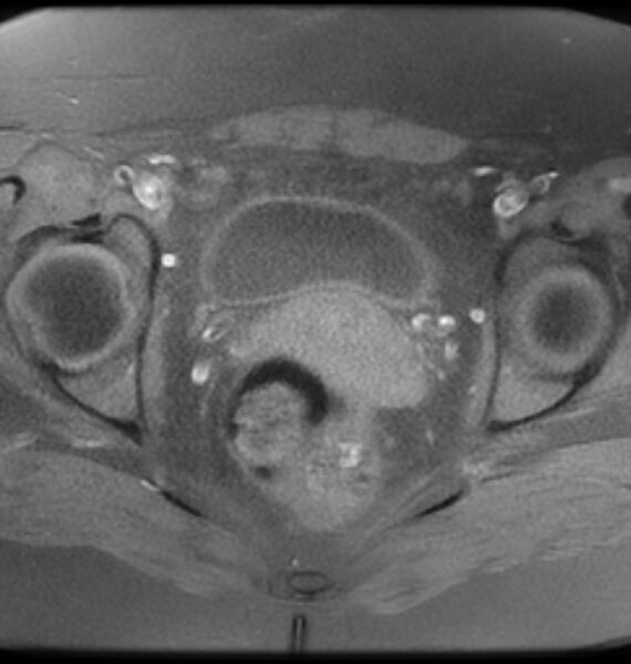 File:Broad ligament leiomyoma (Radiopaedia 81634-95516 Axial T1 fat sat 17).jpg