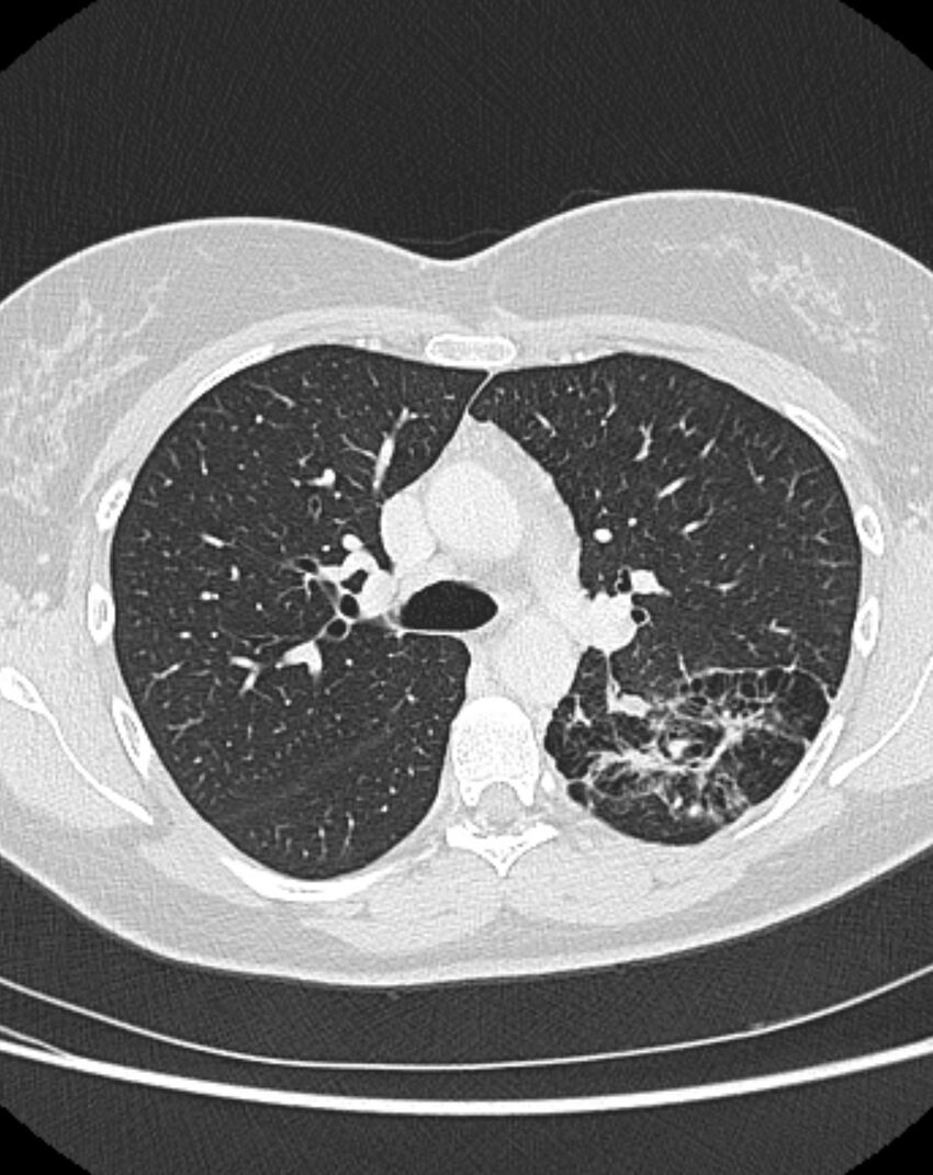 Bronchial atresia (Radiopaedia 50007-55297 Axial lung window 38).jpg