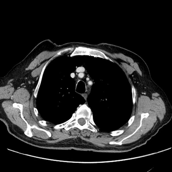 File:Bronchogenic carcinoma with L1 vertebra metastasis (Radiopaedia 9096-9805 Axial C+ delayed 6).jpg