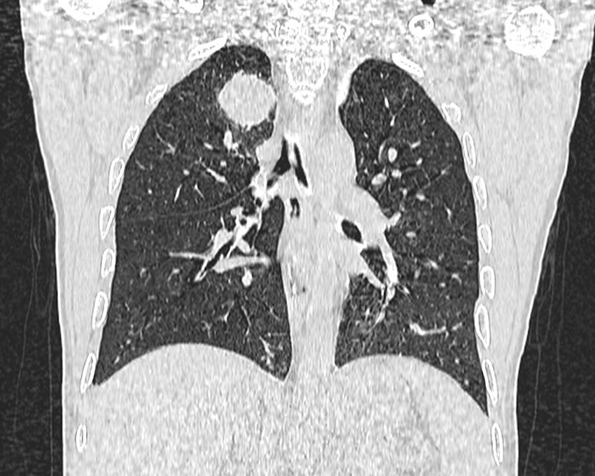 Bronchogenic carcinoma with superior vena cava syndrome (Radiopaedia 36497-38054 Coronal lung window 56).jpg