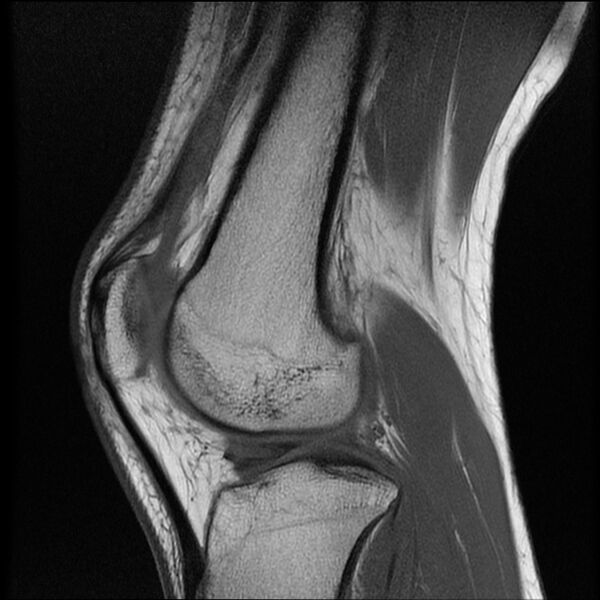 File:Bucket-handle meniscus tear (Radiopaedia 65700-74809 Sagittal T1 15).jpg