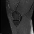Bucket handle tear - lateral meniscus (Radiopaedia 7246-8187 Sagittal T2 fat sat 21).jpg