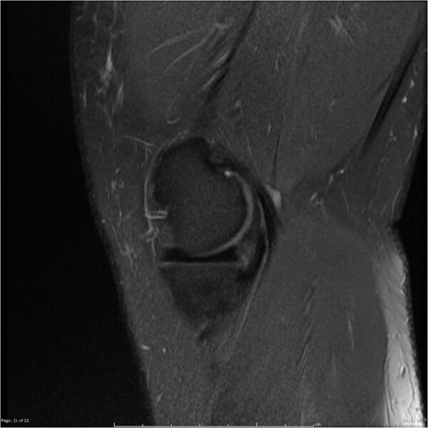 File:Bucket handle tear - lateral meniscus (Radiopaedia 7246-8187 Sagittal T2 fat sat 21).jpg