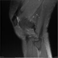 Bucket handle tear - lateral meniscus (Radiopaedia 7246-8187 Sagittal T2 fat sat 5).jpg