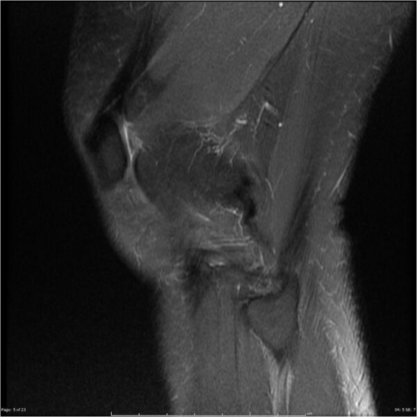File:Bucket handle tear - lateral meniscus (Radiopaedia 7246-8187 Sagittal T2 fat sat 5).jpg