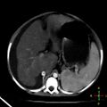 Budd-Chiari syndrome (Radiopaedia 23072-23103 C+ arterial phase 8).jpg