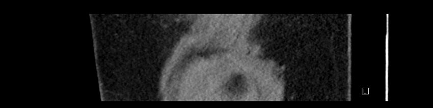 Buried bumper syndrome - gastrostomy tube (Radiopaedia 63843-72575 Sagittal Inject 5).jpg