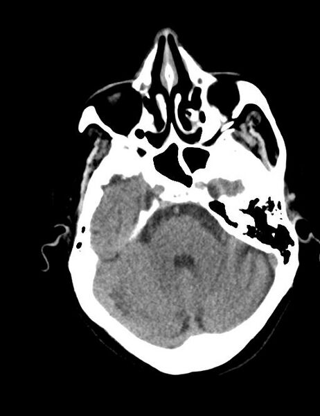 File:Burnt-out meningioma (Radiopaedia 51557-57337 Axial non-contrast 10).jpg