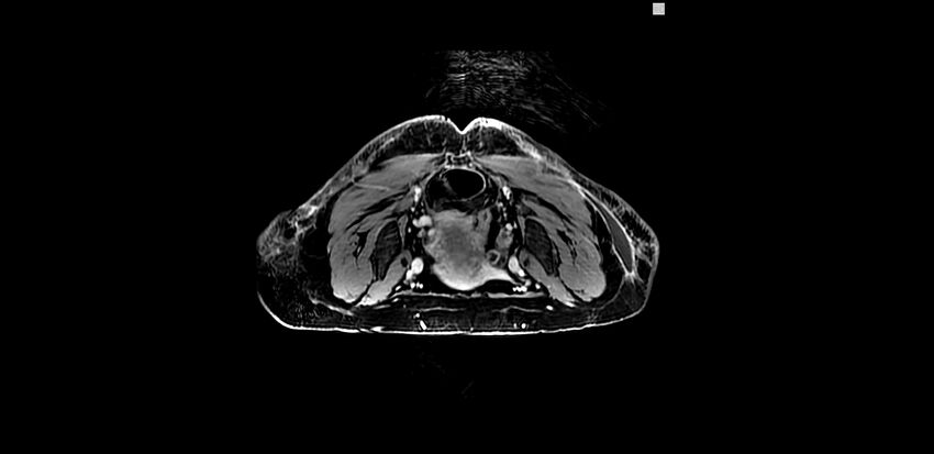 Buttock filler complications (Radiopaedia 63497-72115 Axial T1 C+ 14).jpg