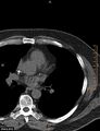 Calcified cardiac fibroma (Radiopaedia 39267-41519 Axial non-contrast 5).jpg