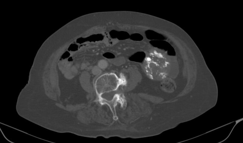 File:Calcified fibroids (Radiopaedia 20306-20228 Axial bone window 2).jpg