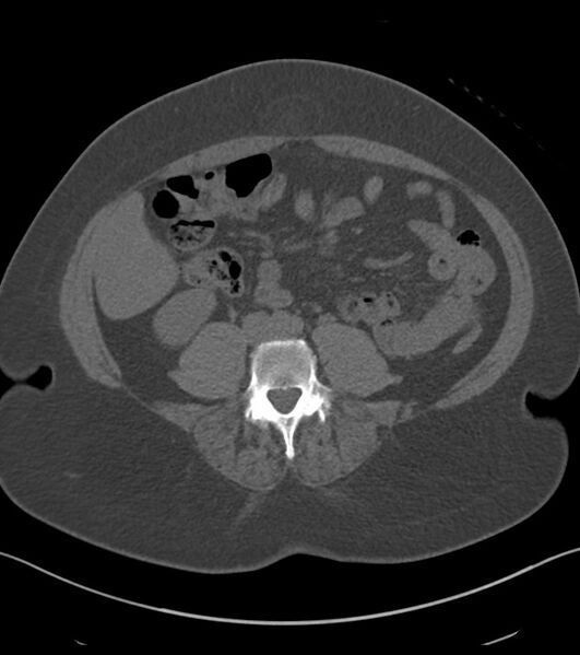 File:Calcified hepatic hydatid cyst (Radiopaedia 81127-94738 Axial non-contrast 61).jpg